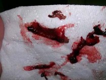 Hiện tượng kinh nguyệt màu đen