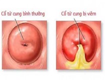 Viêm cổ tử cung: nguyên nhân, triệu chứng và cách điều trị