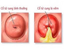 Viêm cổ tử cung: nguyên nhân, triệu chứng và cách điều trị