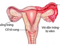 Viêm vòi trứng và những điều cần biết