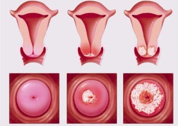 hình ảnh viêm lộ tuyến cổ tử cung
