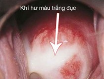 Ra nhiều khí hư màu trắng đục là biểu hiện của bệnh gì?