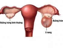 6 điều cần biết về bệnh u nang buồng trứng