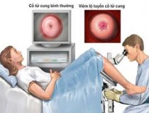 Đốt điện viêm lộ tuyến cổ tử cung có gây vô sinh?