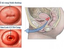Viêm loét cổ tử cung qua từng giai đoạn