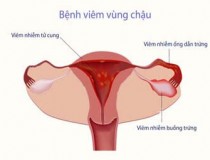 Viêm vùng chậu: nguyên nhân, triệu chứng và hình ảnh