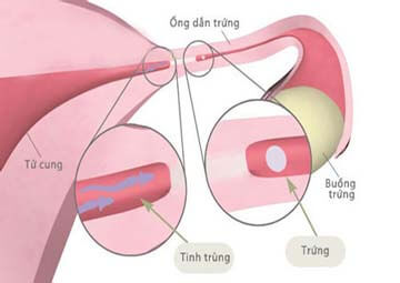 Biểu hiện bệnh viêm tắc vòi trứng
